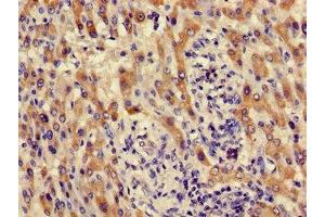 Immunohistochemistry of paraffin-embedded human liver cancer using ABIN7142142 at dilution of 1:100 (ACMSD antibody  (AA 33-129))