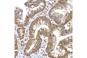 Immunohistochemistry of paraffin-embedded human colon carcinoma using PPCS Rabbit mAb (ABIN7269360) at dilution of 1:25 (40x lens). (PPCS antibody)