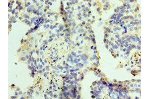 Immunohistochemistry of paraffin-embedded human lung cancer using ABIN7176096 at dilution of 1:100