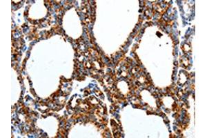 The image on the left is immunohistochemistry of paraffin-embedded Human thyroid cancer tissue using ABIN7191529(MTNR1A Antibody) at dilution 1/40, on the right is treated with synthetic peptide. (Melatonin Receptor 1A antibody)