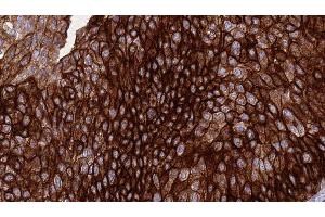 ABIN6276414 at 1/100 staining Human urothelial cancer tissue by IHC-P. (ERBB3 antibody  (C-Term))