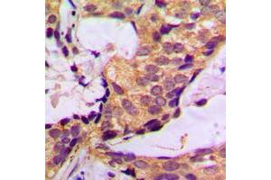 Immunohistochemical analysis of Histone Deacetylase 6 staining in human breast cancer formalin fixed paraffin embedded tissue section. (HDAC6 antibody  (N-Term))