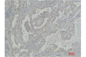 Immunohistochemistry (IHC) analysis of paraffin-embedded Human Lung Carcinoma using Akt2 Polyclonal Antibody. (AKT2 antibody)