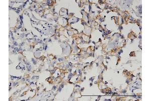 Immunoperoxidase of monoclonal antibody to QPCT on formalin-fixed paraffin-embedded human breast cancer. (QPCT antibody  (AA 262-359))