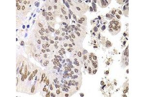 Immunohistochemistry of paraffin-embedded Human colon carcinoma using SOX5 Polyclonal Antibody at dilution of 1:100 (40x lens). (SOX5 antibody)