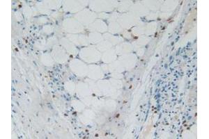 IHC-P analysis of Human Skin Cancer Tissue, with DAB staining. (RNASE3 antibody  (AA 30-154))