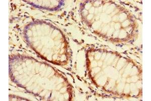 Immunohistochemistry of paraffin-embedded human colon cancer using ABIN7165390 at dilution of 1:100 (FAM131A antibody  (AA 1-281))