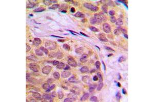 Immunohistochemical analysis of HSPA14 staining in human breast cancer formalin fixed paraffin embedded tissue section. (HSPA14 antibody  (C-Term))