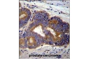 Y Antibody (C-term) (ABIN655601 and ABIN2845085) immunohistochemistry analysis in formalin fixed and paraffin embedded human prostate carcinoma followed by peroxidase conjugation of the secondary antibody and DAB staining. (YI016 (AA 253-280), (C-Term) antibody)