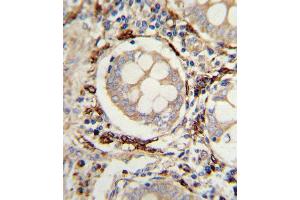 Formalin-fixed and paraffin-embedded human colon carcinoma with AOC3 Antibody (Center), which was peroxidase-conjugated to the secondary antibody, followed by DAB staining.