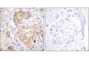 Immunohistochemistry analysis of paraffin-embedded human breast carcinoma tissue, using PKC delta (Ab-505) Antibody. (PKC delta antibody  (AA 471-520))