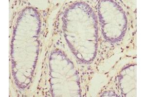 Immunohistochemistry of paraffin-embedded human colon cancer using ABIN7170671 at dilution of 1:100 (SKAP2 antibody  (AA 1-120))