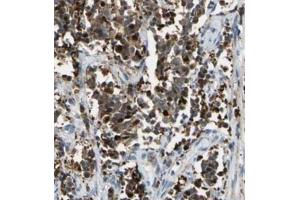 Immunohistochemistry analysis of paraffin-embedded human cervical cancer using BACH1 antibody at dilution of 1/100.