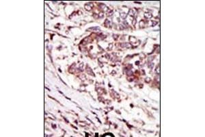 Formalin-fixed and paraffin-embedded human cancer tissue reacted with the primary antibody, which was peroxidase-conjugated to the secondary antibody, followed by AEC staining. (CAMK1G antibody  (C-Term))