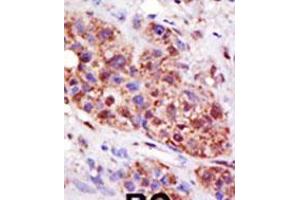 Formalin-fixed and paraffin-embedded human cancer tissue reacted with the primary antibody, which was peroxidase-conjugated to the secondary antibody, followed by DAB staining. (UBE2B antibody  (C-Term))