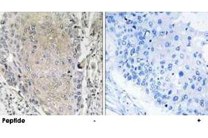 Immunohistochemistry analysis of paraffin-embedded human lung carcinoma tissue using CBLN3 polyclonal antibody .
