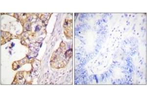 Immunohistochemistry analysis of paraffin-embedded human colon carcinoma tissue, using Keratin 8 (Ab-431) Antibody. (KRT8 antibody  (AA 401-450))