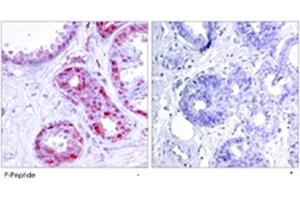 Immunohistochemical analysis of paraffin-embedded human breast carcinoma tissue using JUN (phospho S243) polyclonal antibody . (C-JUN antibody  (pSer243))