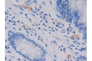 Detection of GC in Human Stomach cancer Tissue using Polyclonal Antibody to Glycocalicin (GC) (Glycocalicin antibody  (AA 136-276))