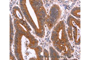 Immunohistochemistry of Human liver cancer using CRISP3 Polyclonal Antibody at dilution of 1:40