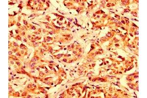 IHC image of ABIN7159933 diluted at 1:300 and staining in paraffin-embedded human liver cancer performed on a Leica BondTM system. (LETM1 antibody  (AA 443-543))