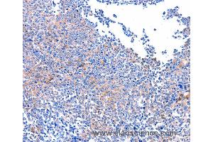Immunohistochemistry of Human ovarian cancer using PTK2 Polyclonal Antibody at dilution of 1:75 (FAK antibody)