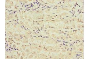 Immunohistochemistry of paraffin-embedded human gastric cancer using ABIN7168157 at dilution of 1:100 (Ribose 5-Phosphate Isomerase A (RPIA) (AA 82-311) antibody)