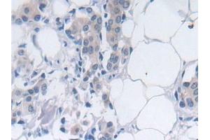 Detection of SRY in Human Breast cancer Tissue using Polyclonal Antibody to Sex Determining Region Y (SRY) (SRY antibody  (AA 1-204))