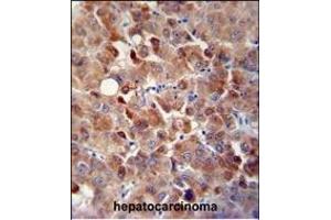 CHRDL1 antibody (N-term) (ABIN654624 and ABIN2844321) immunohistochemistry analysis in formalin fixed and paraffin embedded human hepatocarcinoma followed by peroxidase conjugation of the secondary antibody and DAB staining.