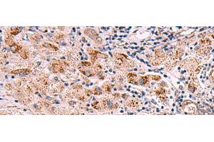 Immunohistochemistry of paraffin-embedded Human liver cancer tissue using INPP5B Polyclonal Antibody at dilution of 1:40(x200)
