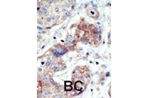 Formalin-fixed and paraffin-embedded human cancer tissue reacted with the primary antibody, which was peroxidase-conjugated to the secondary antibody, followed by DAB staining. (EPH Receptor B3 antibody  (N-Term))