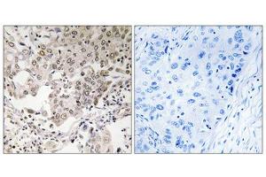 Immunohistochemistry analysis of paraffin-embedded human lung carcinoma tissue using NCAPG2 antibody.