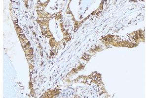 ABIN6275352 at 1/100 staining Human lung cancer tissue by IHC-P. (PEX2 antibody  (Internal Region))