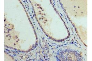 Immunohistochemistry of paraffin-embedded human prostate cancer using ABIN7152009 at dilution of 1:100 (GATA1 antibody  (AA 39-153))