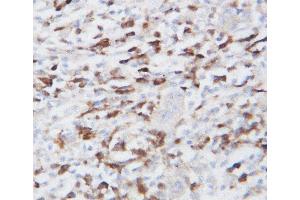 Anti-GRP94 antibody, IHC(P) IHC(P): Human Lung Cancer Tissue (GRP94 antibody  (Middle Region))
