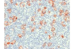 IHC testing of FFPE Hodgkin's Lymphoma with recombinant CD30 antibody (clone rCD30/412).