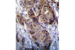 Immunohistochemistry (IHC) image for anti-Melanoma Antigen Family A, 12 (MAGEA12) antibody (ABIN3002530) (MAGEA12 antibody)