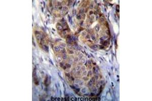 Immunohistochemistry (IHC) image for anti-Melanoma Antigen Family A, 12 (MAGEA12) antibody (ABIN3002530)