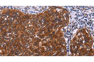 Immunohistochemistry of paraffin-embedded Human cervical cancer tissue using USP2 Polyclonal Antibody at dilution 1:40 (USP2 antibody)