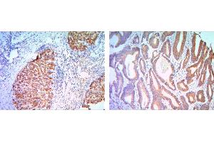 Immunohistochemical analysis of paraffin-embedded liver cancer (right) and colon cancer tissues (left) using KLHL11 mouse mAb with DAB staining. (KLHL11 antibody)