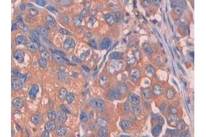 IHC-P analysis of Human Breast cancer Tissue, with DAB staining. (Complement Factor B antibody  (AA 35-160))