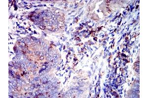 Immunohistochemical analysis of paraffin-embedded rectum cancer tissues using CD53 mouse mAb with DAB staining. (CD53 antibody)