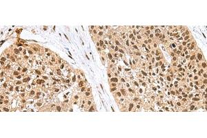 Immunohistochemistry of paraffin-embedded Human esophagus cancer tissue using FBXO32 Polyclonal Antibody at dilution of 1:60(x200) (FBXO32 antibody)