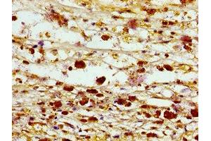 Immunohistochemistry of paraffin-embedded human melanoma using ABIN7161402 at dilution of 1:100 (Septin 3 antibody  (AA 238-358))