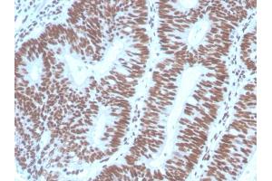 Formalin-fixed, paraffin-embedded human Colon Carcinoma stained with PAX2 Mouse Monoclonal Antibody (PAX2/1104). (PAX2A antibody  (AA 223-354))