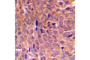 Immunohistochemical analysis of EIF2S1 staining in human breast cancer formalin fixed paraffin embedded tissue section. (EIF2S1 antibody  (Center))