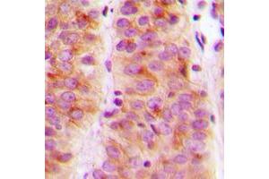 Immunohistochemical analysis of SLK staining in human breast cancer formalin fixed paraffin embedded tissue section. (SLK antibody  (C-Term))