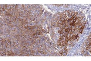 ABIN6276957 at 1/100 staining Human urothelial cancer tissue by IHC-P.