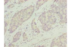 Immunohistochemistry of paraffin-embedded human gastric cancer using ABIN7163654 at dilution of 1:100
