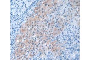 Detection of PANX1 in Human Liver Cancer Tissue using Polyclonal Antibody to Pannexin 1 (PANX1) (PANX1 antibody  (AA 228-411))